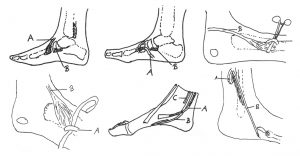 Alternative Tendon Transfers for the Treatment of acquired Flatfoot Deformity