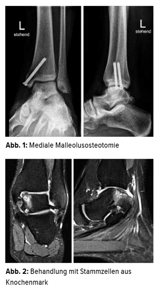 Cartilage Lesion within the Ankle Joint