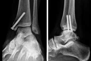 Cartilage Lesion within the Ankle Joint