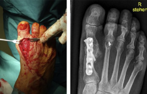 Avascular head necrosis as a complication after Hallux valgus surgery